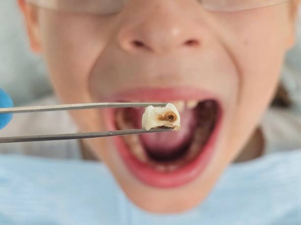 Best Emergency Tooth Extraction in Wakefield, VA